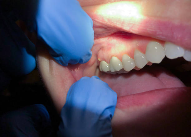 Best Emergency Tooth Extraction in Fincastle, TN